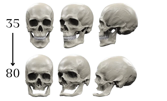 Diagram comparing the skull at approximately 35 years old and at 80 years old, showing changes in facial bone structure