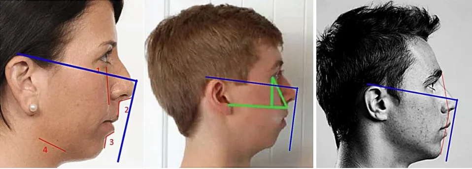 Illustration of a more vertical facial-development pattern