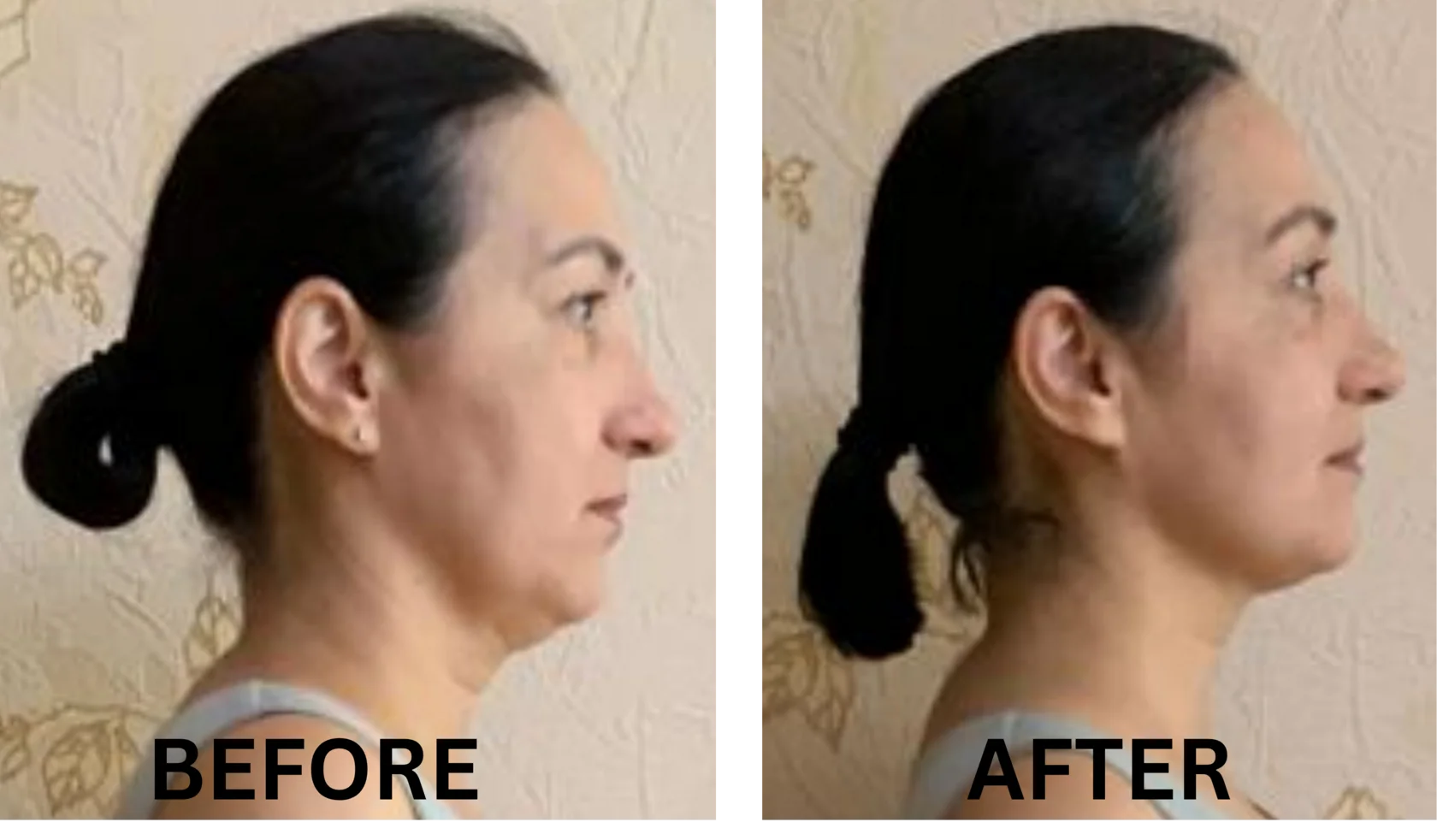 Express Face Sculpt Before and After