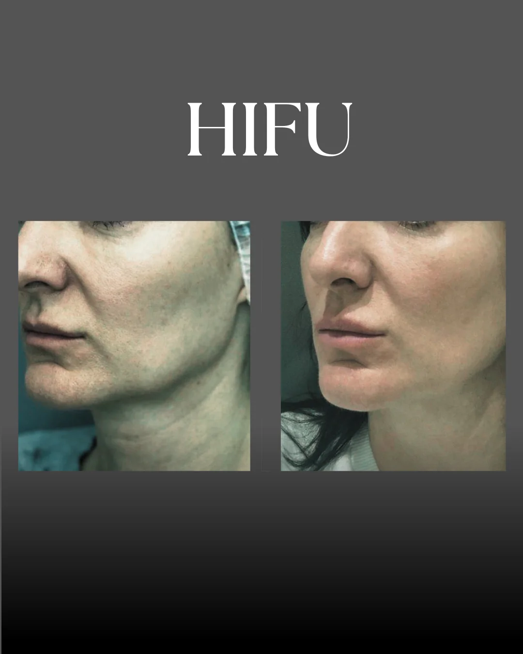 Antes y Después HIFU – Elona Clinic