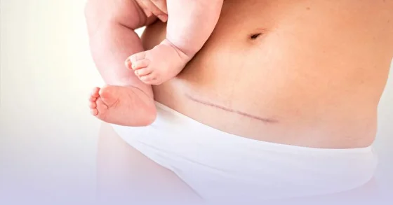 Cicatrice de césarienne — empreinte corporelle