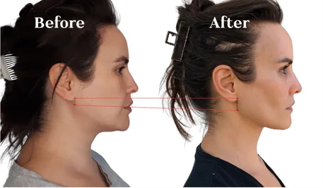 Lilya's before-and-after facial transformation