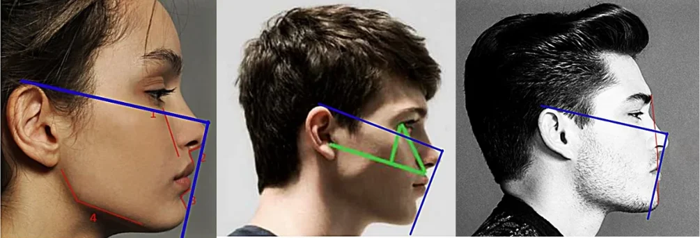 Illustration of a more horizontal facial-development pattern with greater forward and lateral support