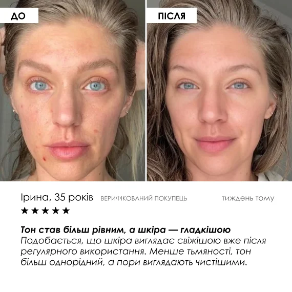 Кислотний пілінг для сяйва шкіри обличчя