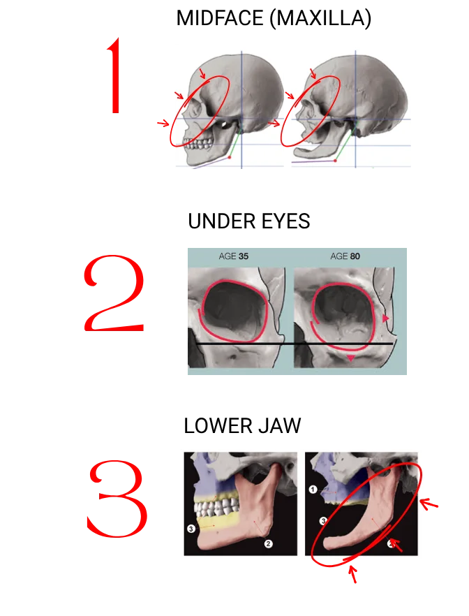 Diagram highlighting three areas of the skull where facial bone resorption is particularly visible
